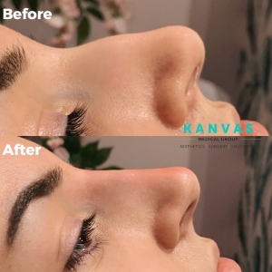 Before and after of liquid rhinoplasty done at Kanvas.