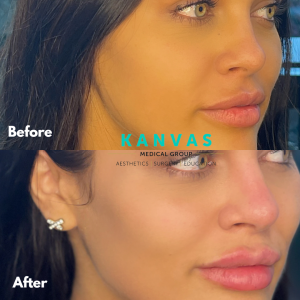 It takes 14 days for the filler to settle and see the final results.