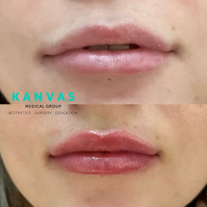 Bespoke Non-surgical Lip Augmentation is available at Kanvas Medical Group.