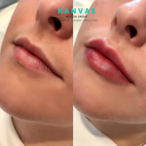 lip filler lip filler