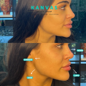 A before and after of jaw / cheek filler treatment.