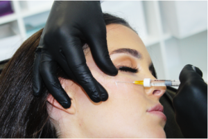 The practitioner will do a thorough consultation and place the filler in the cheeks to lift the area or give a contoured look.