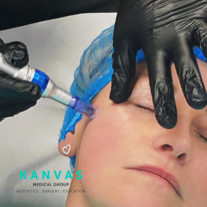 microneedling